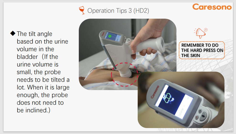 Caresono Blöðruskanni HD2